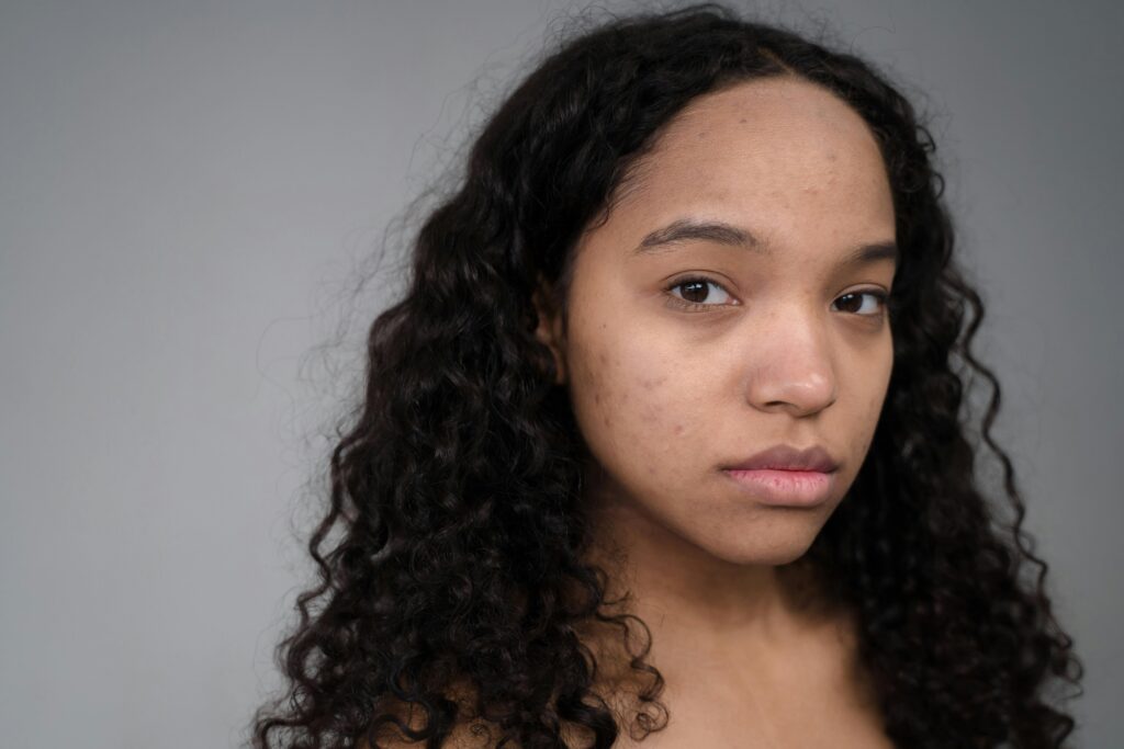 Meisje met acne bij the skin solution