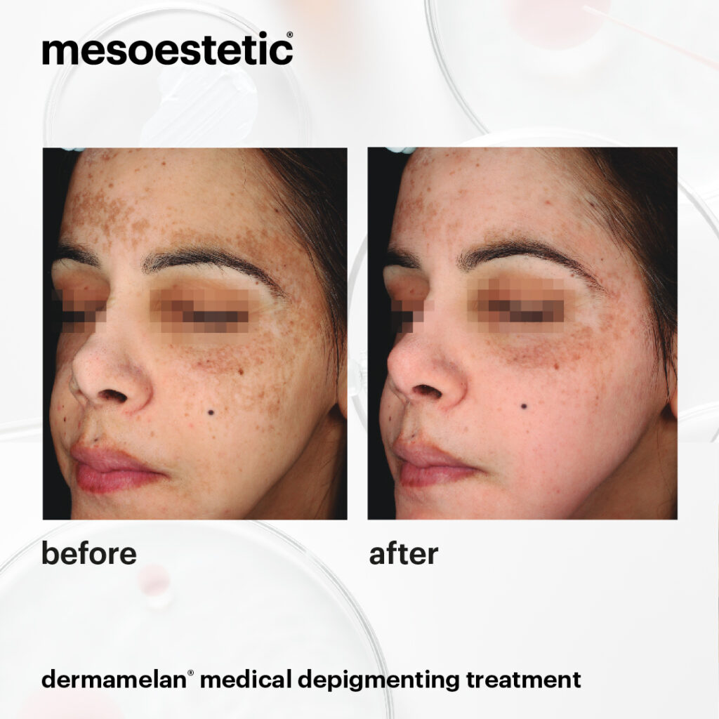 melasma harderwijk